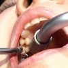ガチ歯科治療美少女若菜しずく銀歯2箇所埋め込み治療