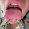 【個人撮影】加護まりの舌ブラシで「汚舌苔」採取